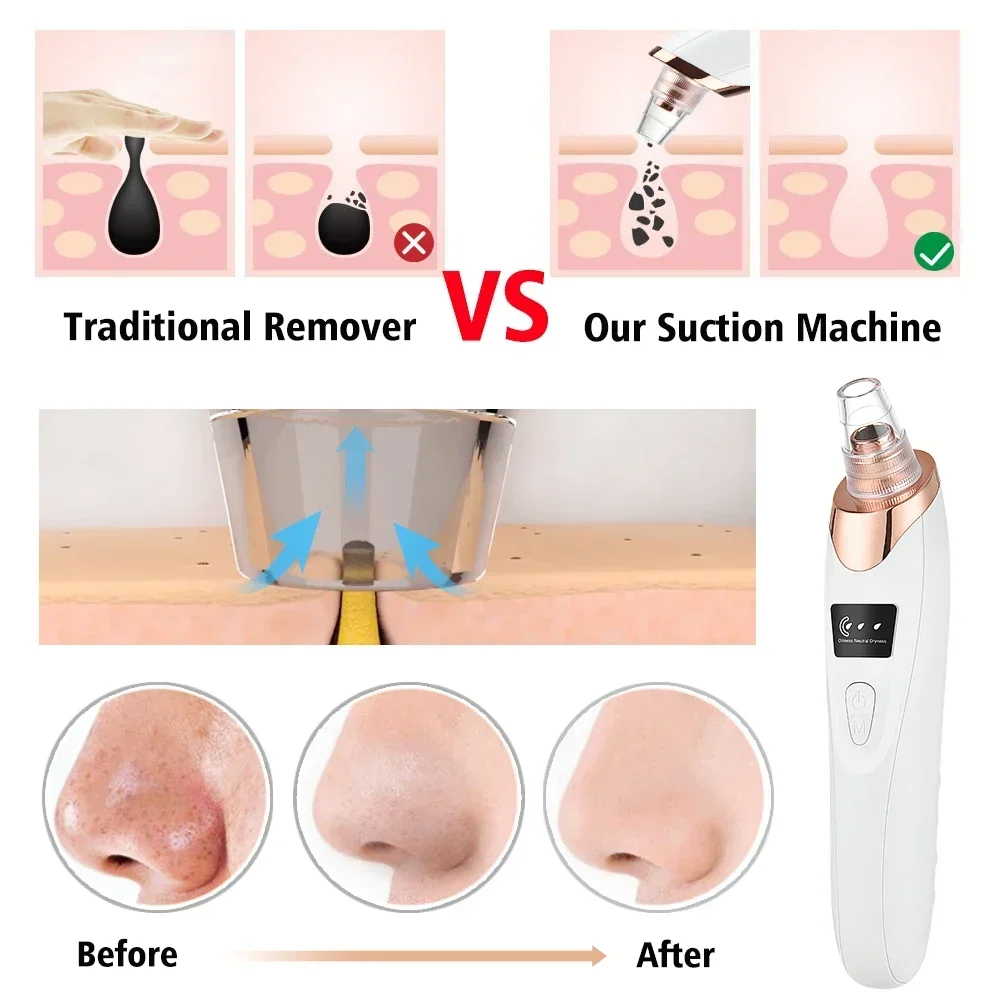 PoreRemover: Oplaadbaar Slim Mee-eters, Witte Mee-eters Poriën Verwijderaar Kit