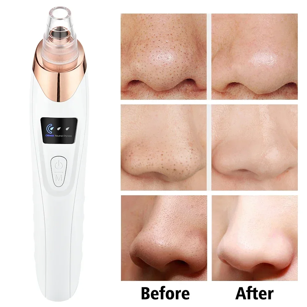 PoreRemover: Oplaadbaar Slim Mee-eters, Witte Mee-eters Poriën Verwijderaar Kit