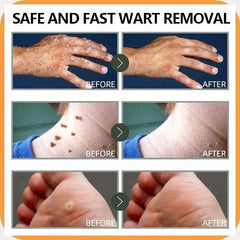WartRemover 1+1 GRATIS: Veilige Huid Wrat Ointment Verwijderaar